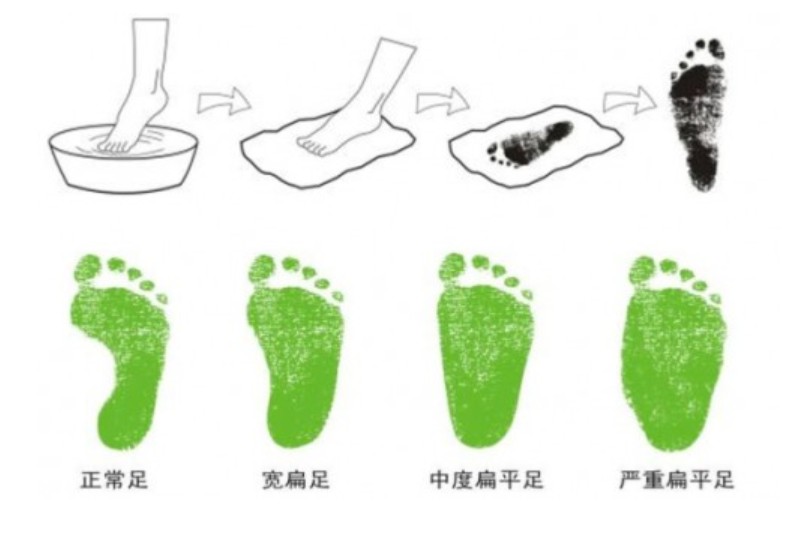 靠谱的扁平足干预知识,矫正鞋怎么穿